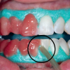 Thumbnail SST™ - Surgy Tips0
